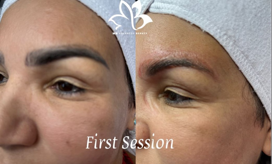 Image 1: Eyebrow Tattoo Removal: Save Up to 30% Off at MB Advanced Beauty MED!