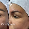 Image 1: Eyebrow Tattoo Removal: Save Up to 30% Off at MB Advanced Beauty MED!