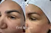 Refresh Your Look - 50% Off Eyebrow Tattoo Removal! at MB Advanced Beauty Med Spa!