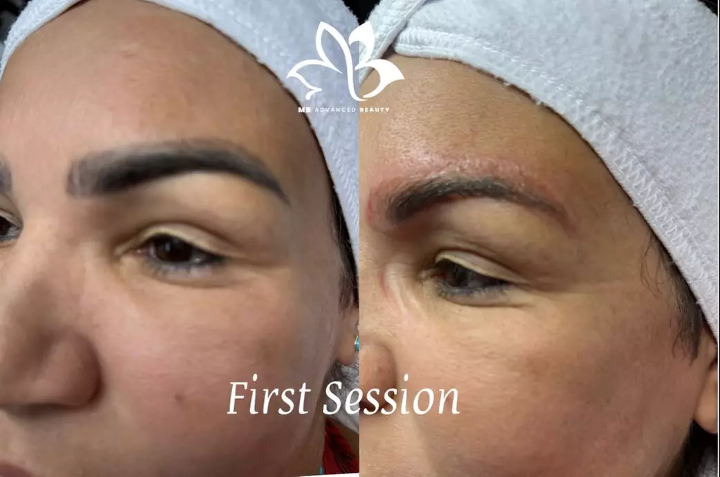 Refresh Your Look - 50% Off Eyebrow Tattoo Removal! at MB Advanced Beauty Med Spa! - Primary Image