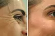 Up to 21% Off 20, 30, or 40 Units of Botox at Celebrity Smiles Aesthetic Institute - Second Medium