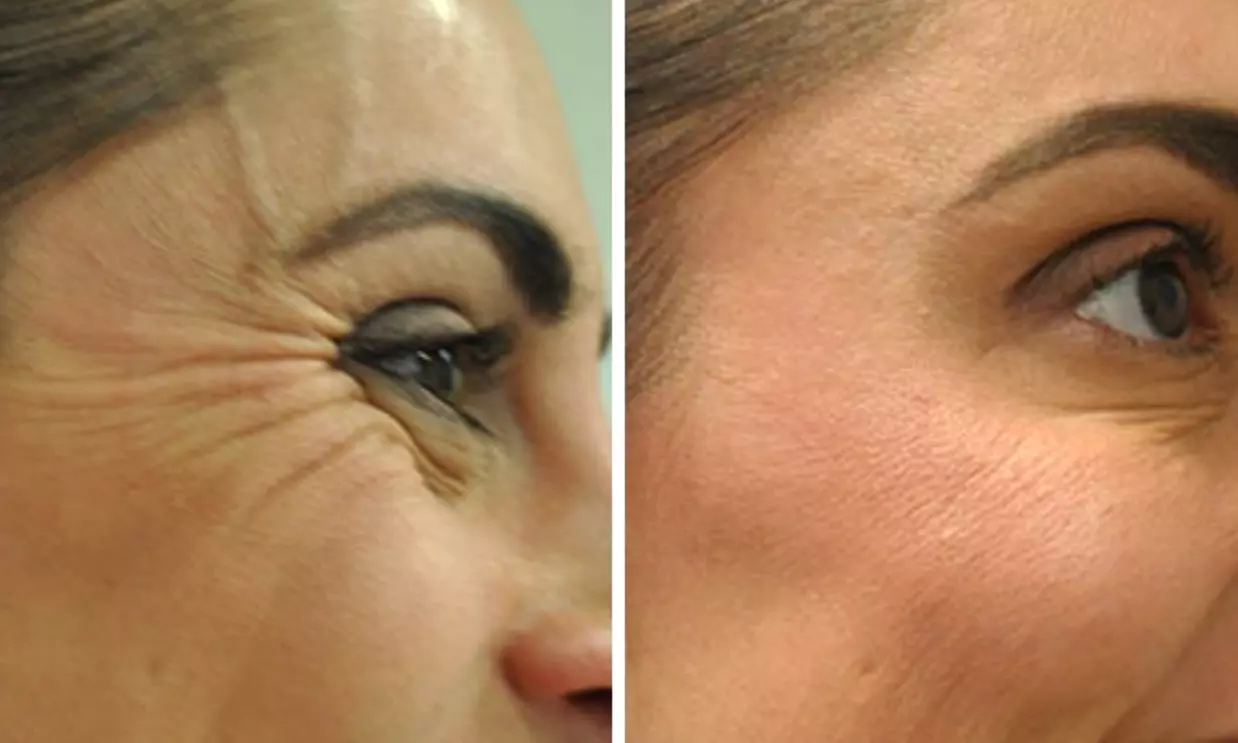 Enhance Your Look with 20, 30, or 40 Units of Botox