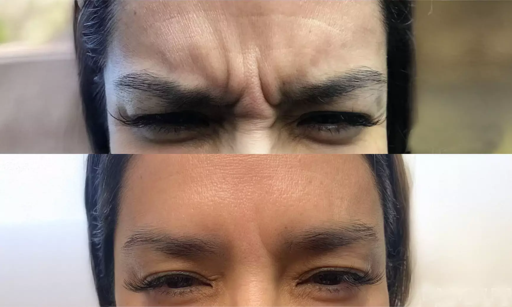 Achieve Youthful Glow with 20 Units of Botox Treatment