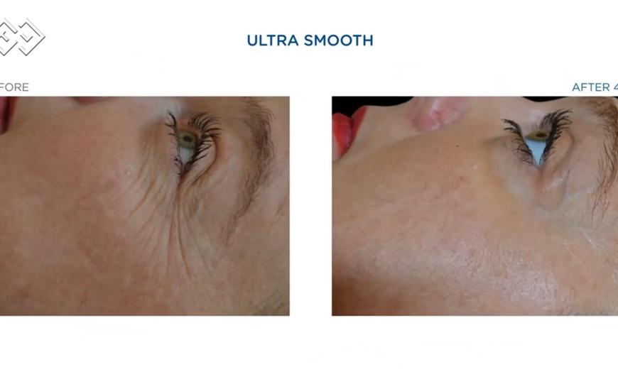 Image 3: Up to 70% Off on Ultrasonic Fat Reduction