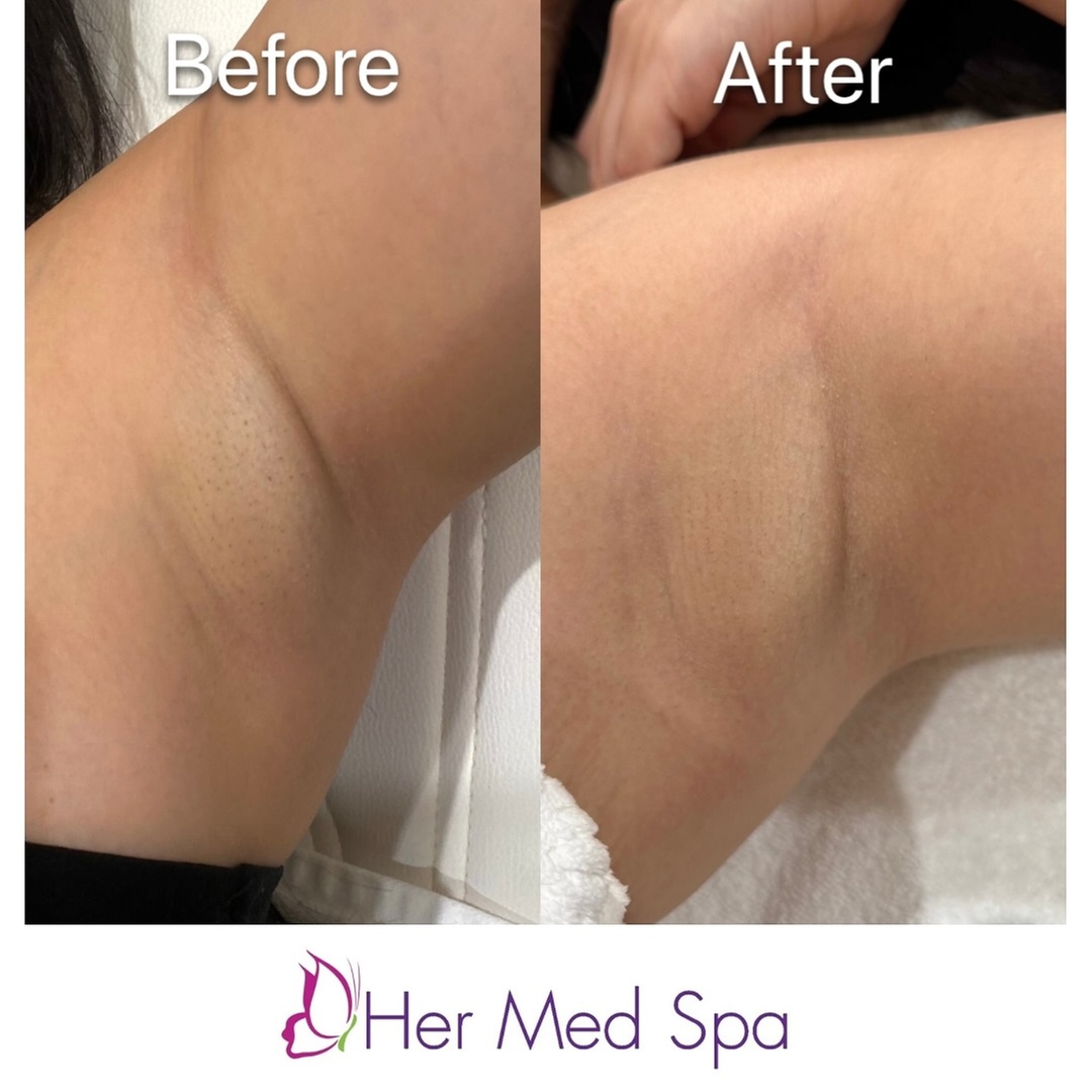 Smooth Skin with Six Laser Hair Removal Sessions