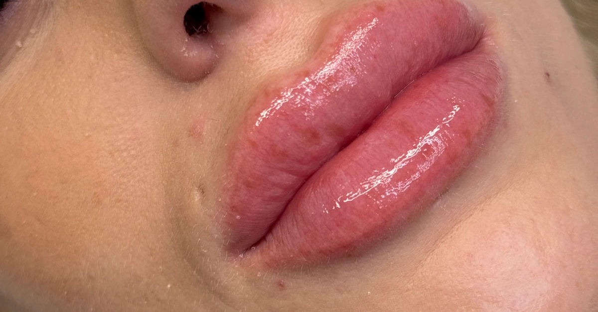 Tratamiento de rehidratación de labios con dermapen en Barcelona