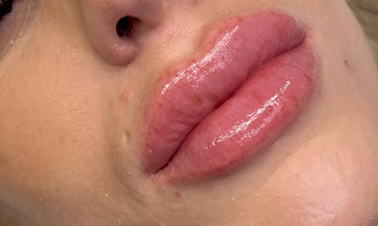 1 o 2 sesiones de rehidratación de labios con dermapen para 1 persona