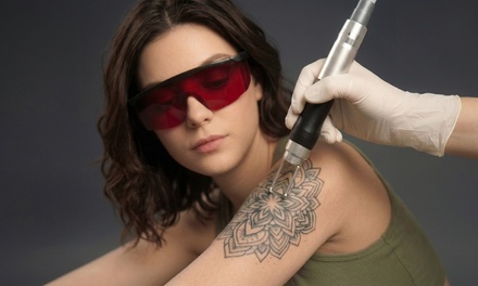 Two Astanza Duality Laser Tattoo Removal Treatments for Area Up to 2''x 4'' - Primary Medicine And Cosmetic Laser Center