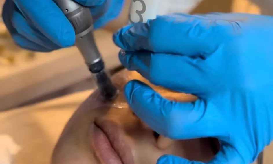 1 oder 2x Microneedling-Gesichtsbehandlung (45-60 Min.) für 1 Person