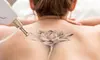 Tattoo Removal: 3 Sessions for Small to Extra-Large Areas at BeamUp (Up to 50% Off)