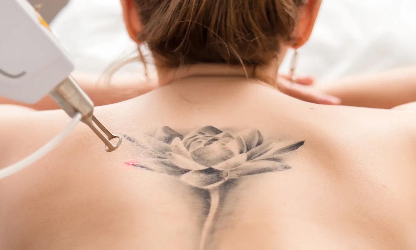 Up to 80% Off on Tattoo Removal at BeamUp
