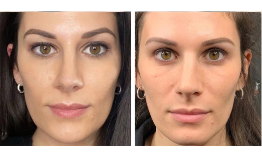 Image 3: Refresh Your Look with One Vial Of Sculptra + Opt 20 Units of Botox