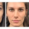 Image 4: Refresh Your Look with One Vial Of Sculptra + Opt 20 Units of Botox