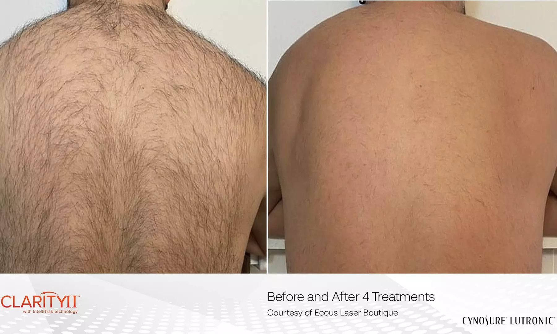 Eight Laser Hair Removal Sessions at Lotus Health & Aesthetics Spa