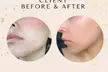 One, Two, or Three 90 Minute PRP Facials for Face & Neck at Excellence Medspa & Brows - Second Medium