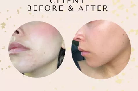 Experience the Benefits of a 90-Minute PRP Facial