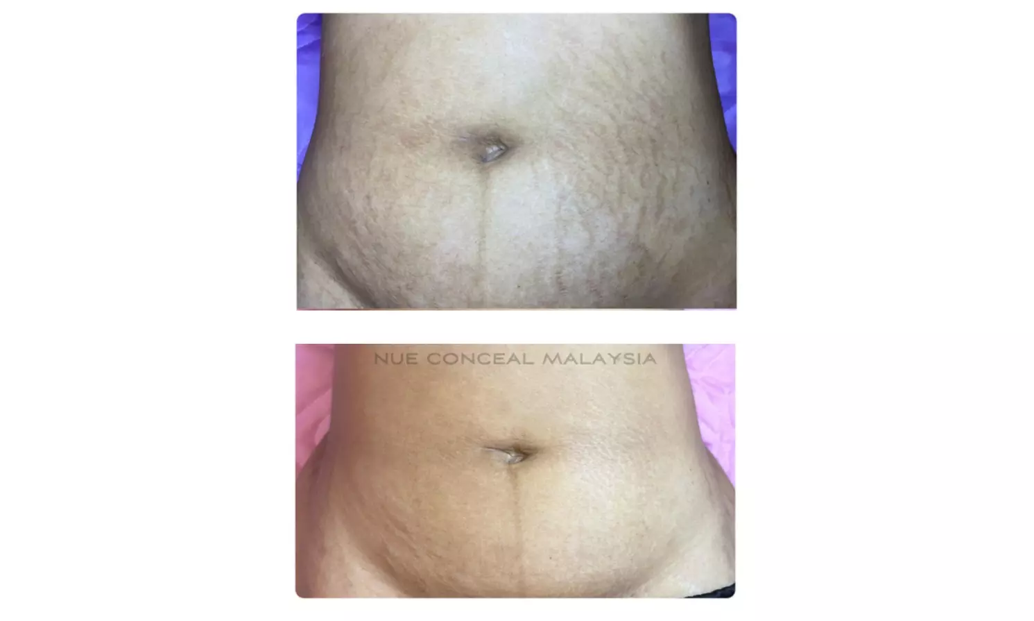 Achieve Smoother Skin with Inkless Tattoos for Stretch Mark Revision