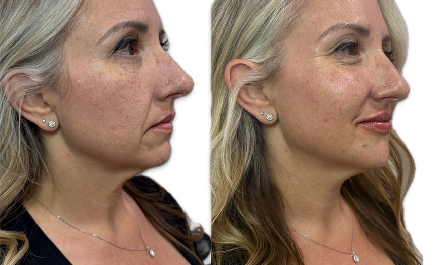 Image 3: Get a Half Syringe or One of the Dermal Fillers