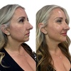Image 3: Get a Half Syringe or One of the Dermal Fillers