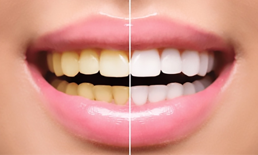 Image 2: Teeth Whitening, Semi Permanent Lip Blush or Powder Brows Perfection 