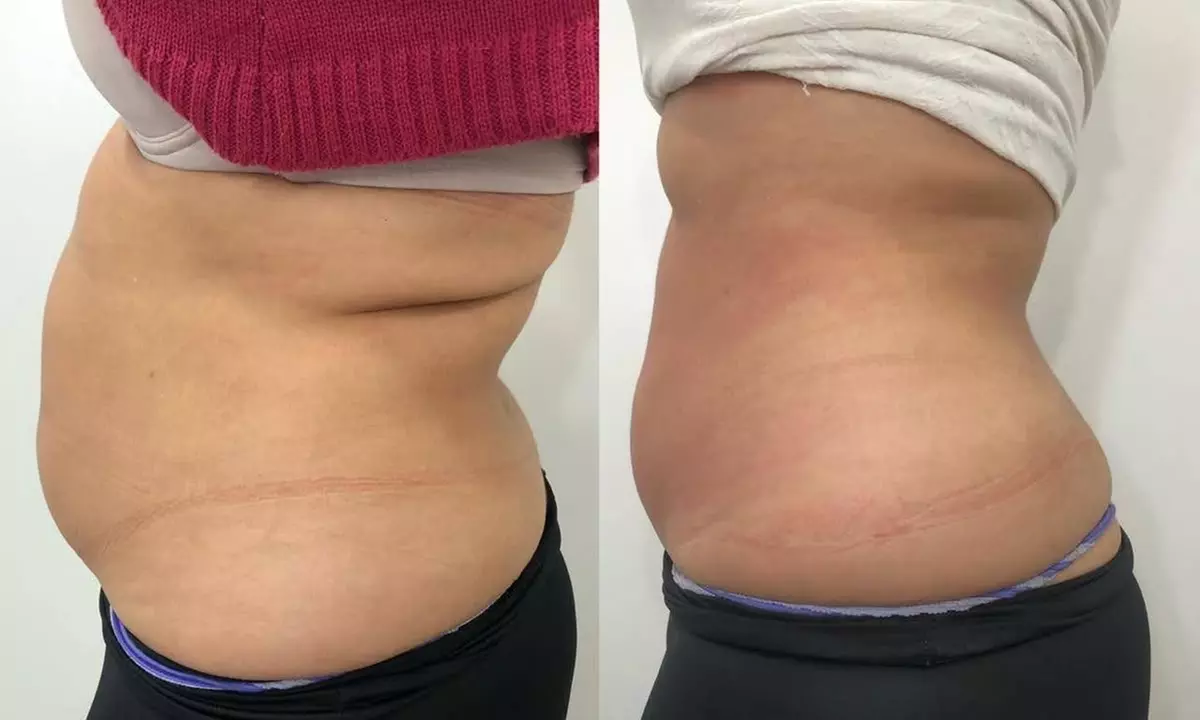 Transform Your Body with Golden Skin's One, Four, or Eight Ultrasonic Cavitation Sessions (Up to 55% Off) - Second Medium