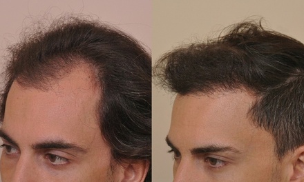 Hair Restoration Treatment with Exosomes (Front Hair Line) - Par Laser