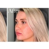 Image 6: 20, 40 Units of Botox or Lip Flip (Up To 10 Units) 