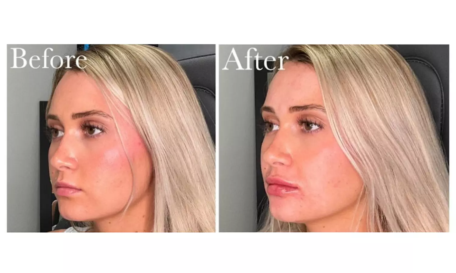 20, 40 Units of Botox or Lip Flip (Up To 10 Units)