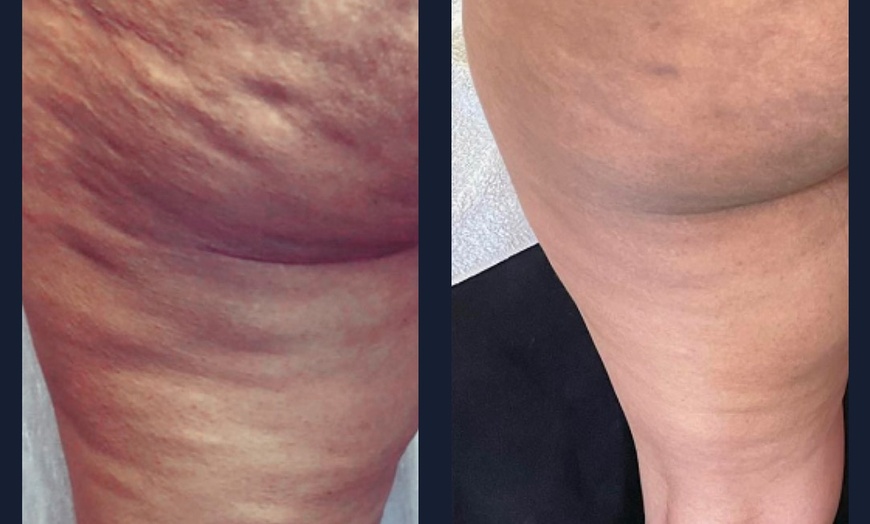 Image 4: Intro Cryo Slimming or 4 or 6 Cryo Contour Sessions
