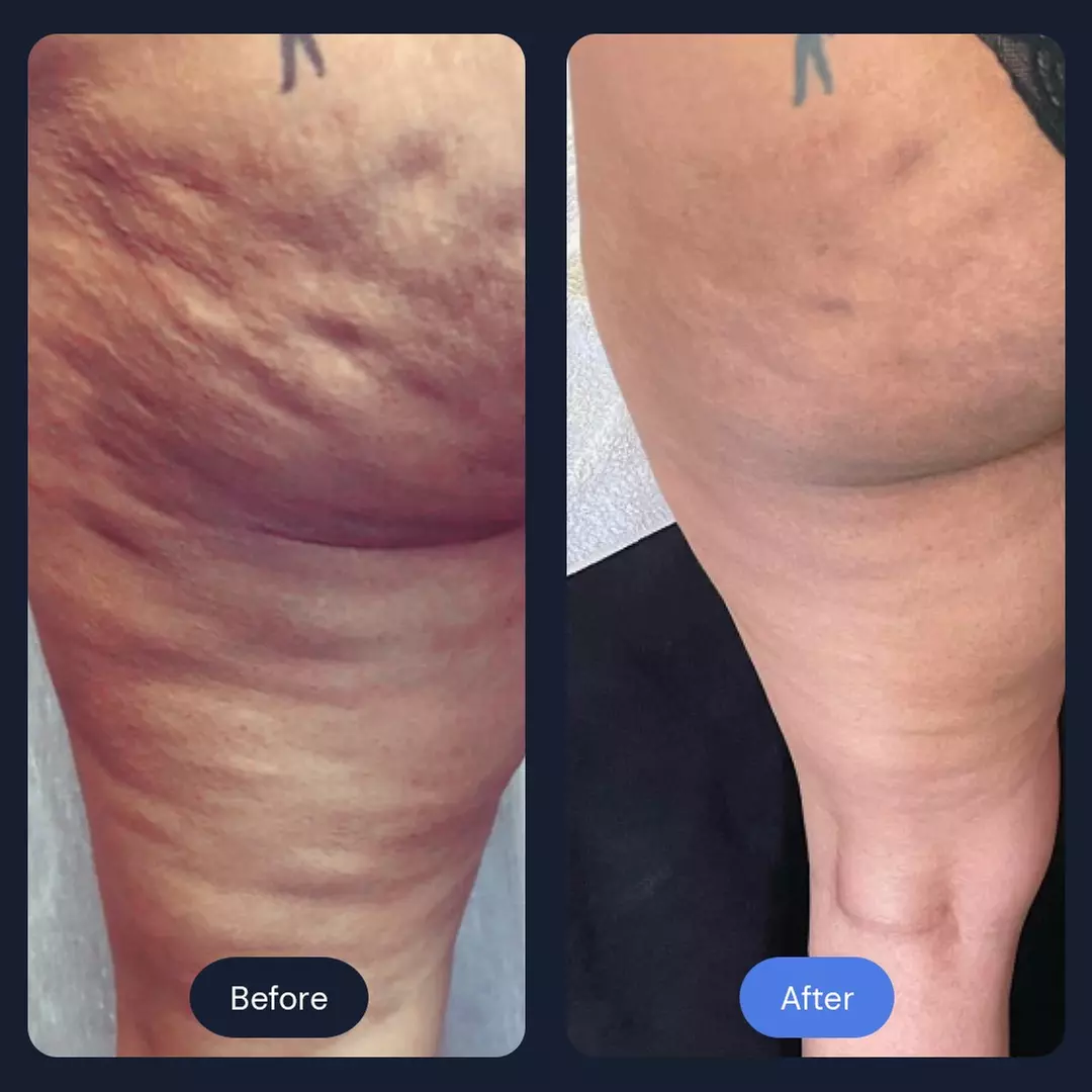 Intro Cryo Slimming or 4 or 6 Cryo Contour Sessions