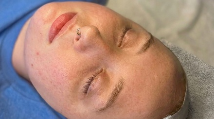 Two Professional Chemical Grade Chemical Peels - Beautiqueen