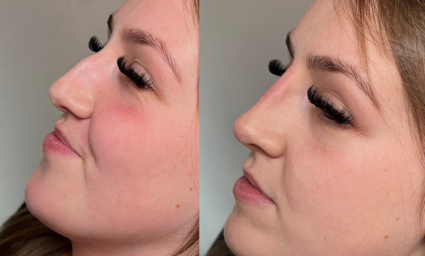 Image 6: 1 or 2 ML For Lip or Chin or Cheek with Consultation