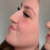 Image 6: 1 or 2 ML For Lip or Chin or Cheek with Consultation