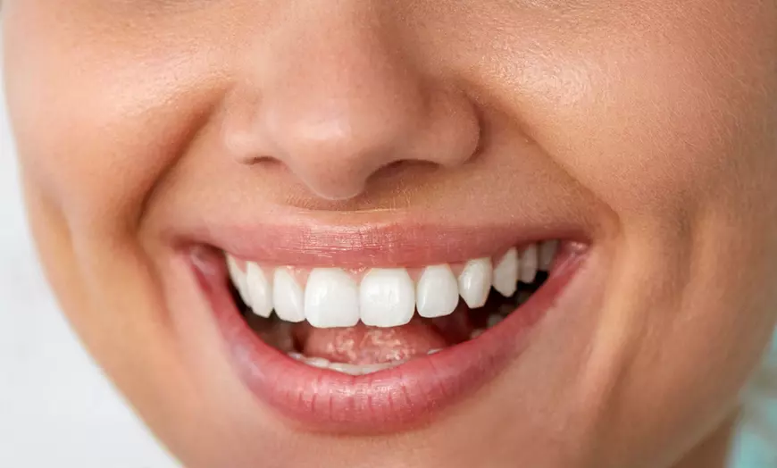 Image 1: Blanqueamiento dental LED con limpieza bucal y fluorización