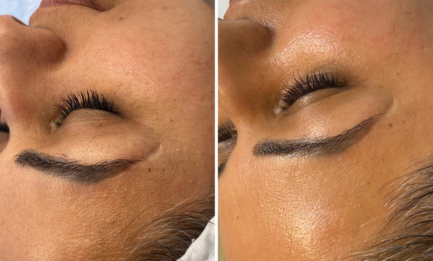 Image 11: Microneedling-Behandlung oder Enzym-Lifting-Paket für 1 Person