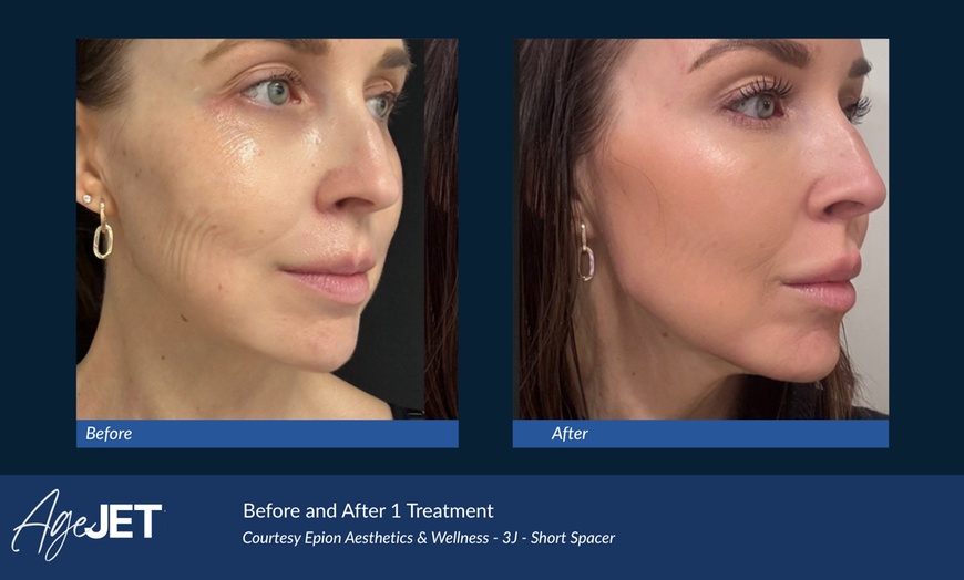Image 7: CO2 Laser Skin Resurfacing Treatment with Optional Peptide 