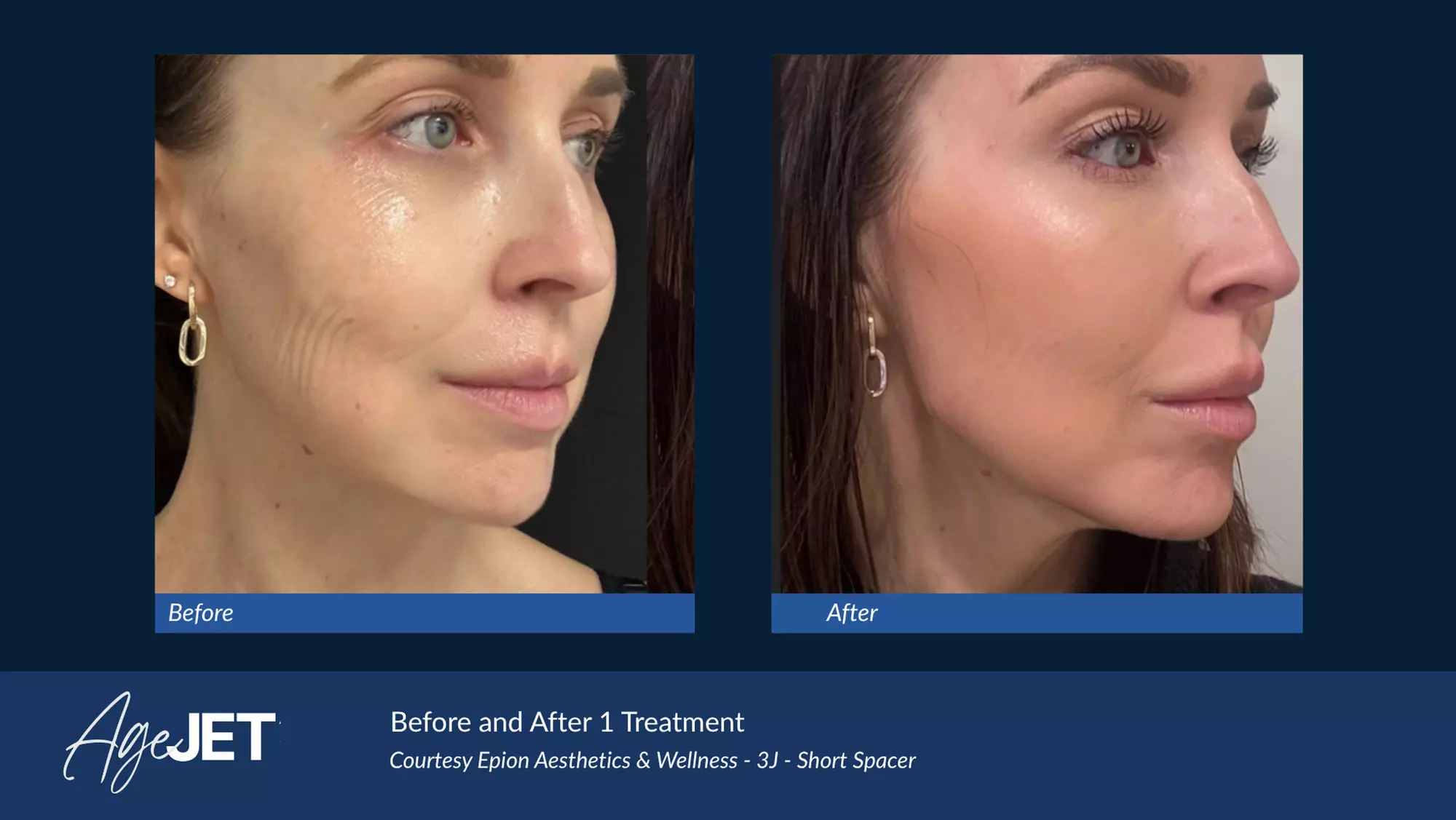 CO2 Laser Skin Resurfacing Treatment with Optional Peptide
