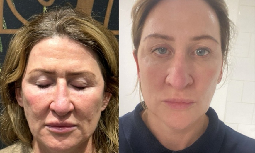 Image 5: Microneedling with Derma 2.0: 1 or 3 Skin-Revitalising Sessions