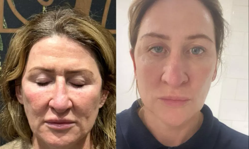 Microneedling with Derma 2.0: 1 or 3 Skin-Revitalising Sessions