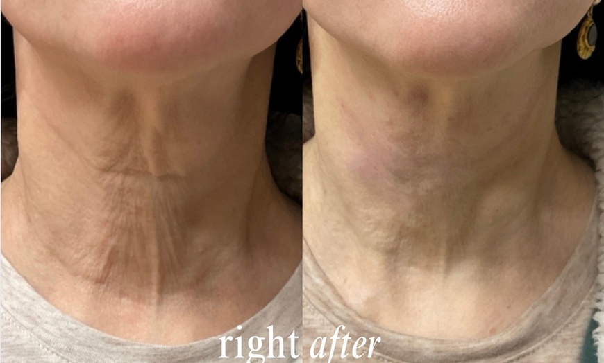 Image 6: Up to 33% Off on Injectables at Hush Aesthetics, LLC