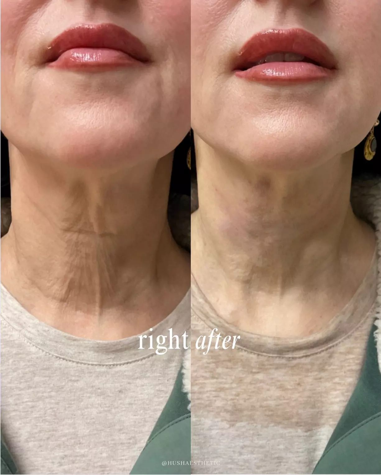 Up to 45% Off on Injectables at Hush Aesthetics, LLC