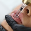 Image 3: Hyaluronpen con hidratación o relleno de labios y reafirmación facial
