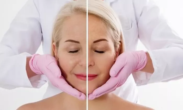 Revitalize with 20 or 40 Units of Botox or One Syringe of Juvederm Ultra XC (Up to 47% Off) - Second Medium