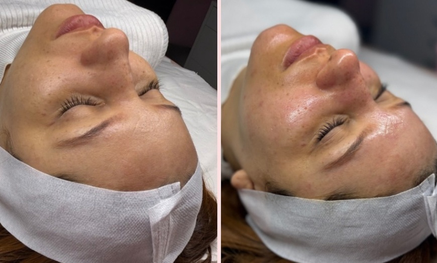 Image 3: Reveal Radiant Skin With Chemical Peels And Vitamin C Glow Boost