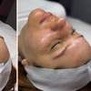 Image 3: Reveal Radiant Skin With Chemical Peels And Vitamin C Glow Boost