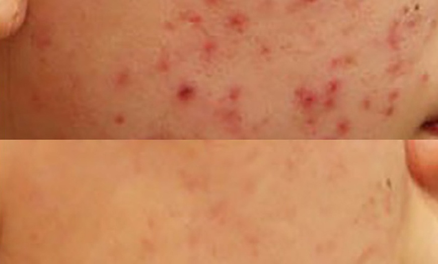 Image 2: 60-Minute Acne Extraction or Enzyme Peel & Hydra Revitalize Facial