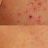 Image 2: 60-Minute Acne Extraction or Enzyme Peel & Hydra Revitalize Facial