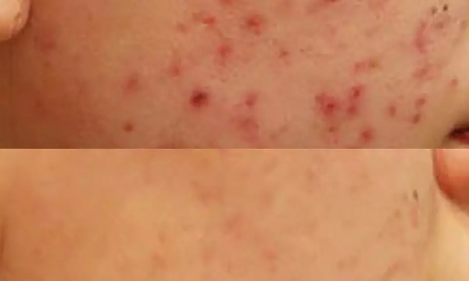 60-Minute Acne Extraction or Enzyme Peel & Hydra Revitalize Facial