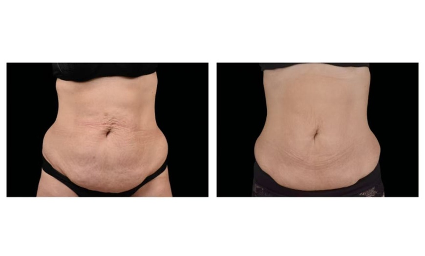 Image 4: One Session Electromagnetic Body Sculpting on One, Two or Four Areas