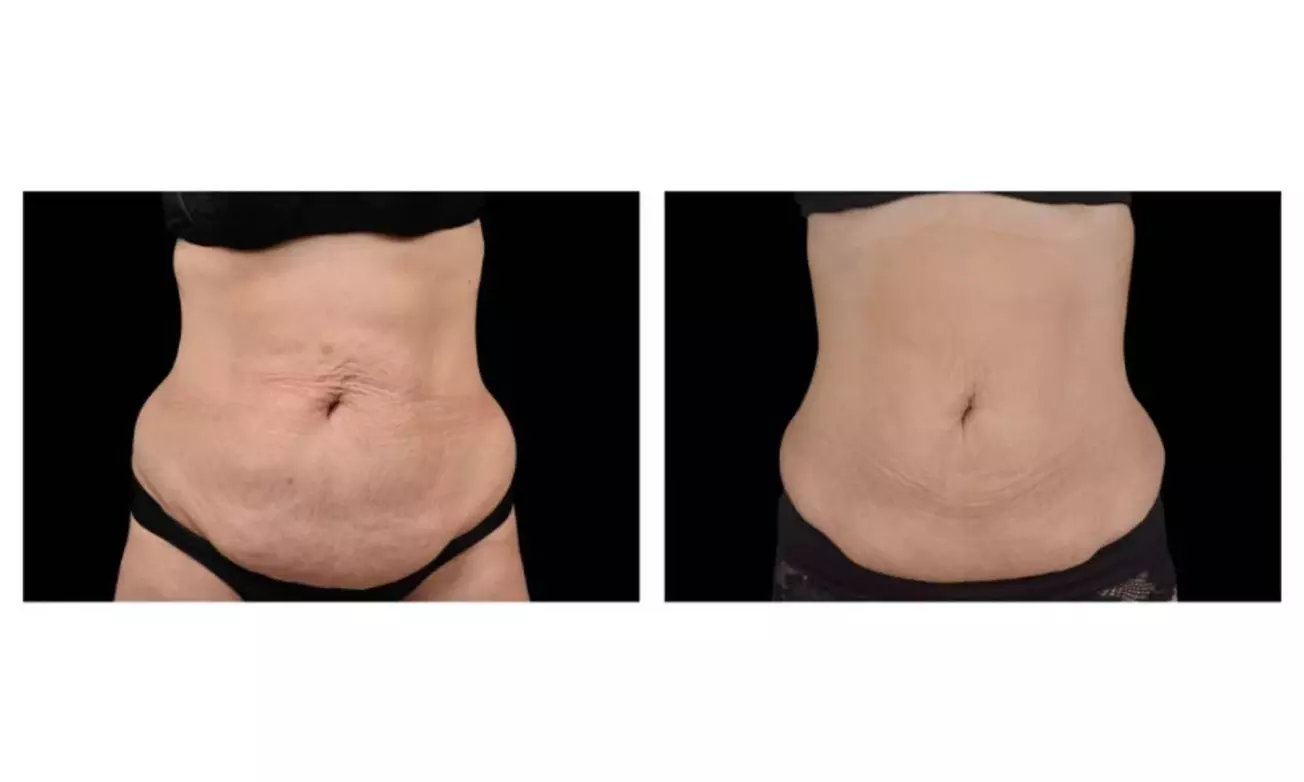 One Session Electromagnetic Body Sculpting on One, Two or Four Areas